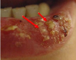 Common Oral Lesions: Part I. Superficial Mucosal Lesions ...